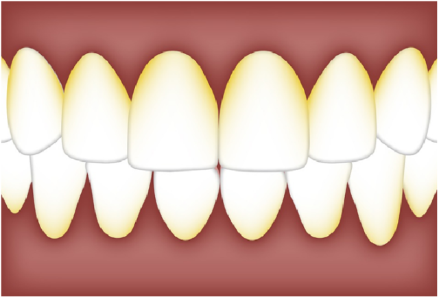 Causes of Dental Plaque and How to Prevent It | News For Public