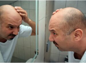 Hair Loss